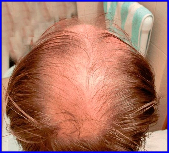 Средство для роста волос сша minoxidil