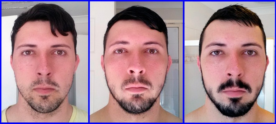 Миноксидил для бороды: фото до и после